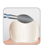 Occlusal/Lingual Reduction